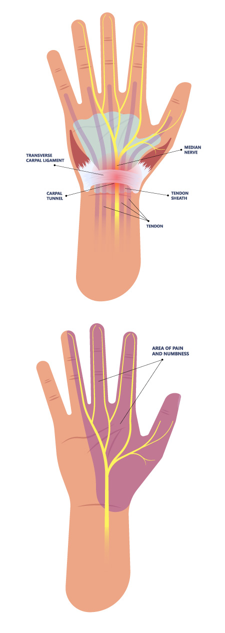 Symptoms of CTS