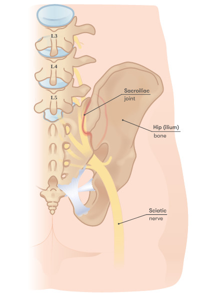 Sciatic nerve is large nerve that runs down the back of the leg